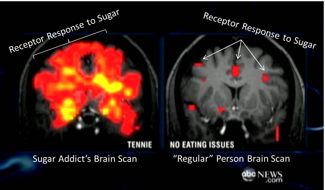 sugar-brain1
