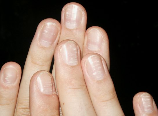 white-spots-nails-leukonychia-punctata